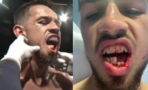 Boxer breaks jaw in half and shares injury on video