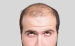 Hair Loss: Can You Fight Against It And Really Eradicate It?