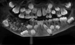 A young boy has 526 teeth removed from his mouth