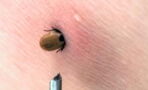 Tick bite: Alarming symptoms and what to do if you've been bitten