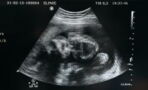 This woman's foetus was pregnant with her own twin brother