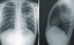 Pneumonia: These symptoms may be a sign of this COVID complication