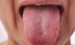COVID tongue: The nasty new coronavirus symptom