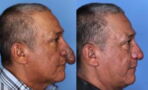 Man with 'penis-like nose' gets an incredible transformation for free