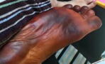 His foot turned black overnight and his wife was to blame!