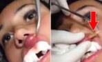 Doctor removes a horrifying parasite hiding inside a woman's lip
