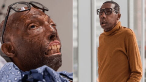 African-American Man Had To Wait Six Years For A Face Transplant That Matched His Skin