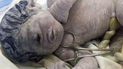 Egyptian woman gives birth to rare 'cyclops' baby