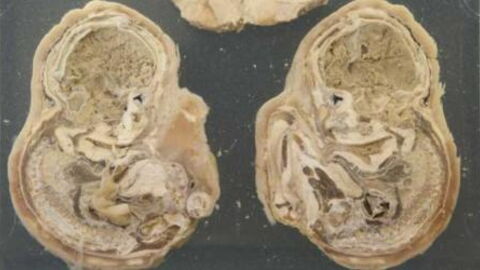 A 75-Year-Old Woman Gave Birth After Being Pregnant for 46 Years