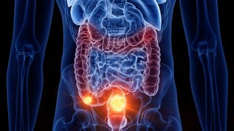 5 Little-Known Colon Cancer Symptoms To Look Out For