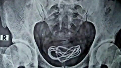 Doctors Found a Charging Cable in This Man’s Bladder-Then They Found Out How It Got There