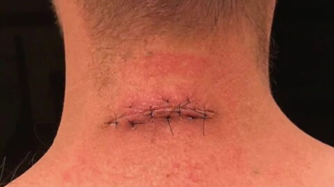 Why we should never ignore sun spots: Doctors had to remove a huge part of this man's neck