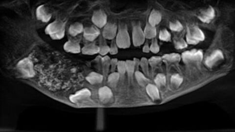 A young boy has 526 teeth removed from his mouth