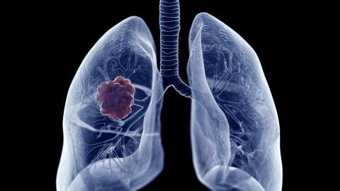 Lung cancer: Study reveals 3 origins of the disease in non-smokers