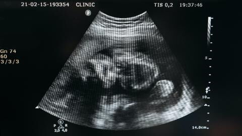 This woman's foetus was pregnant with her own twin brother