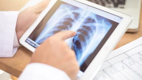 Lung cancer: Doctor warns of a little-known symptom