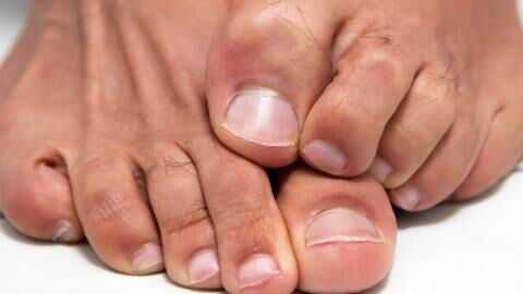 This is why you should never burst 'pimples' on your feet