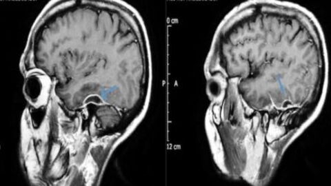 Cotton Swabs Could Have Been the Cause of Death for This 31-Year-Old Man