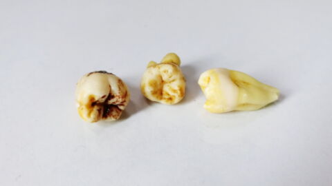 After Years of Having Trouble Breathing This Man Has a 20-Year-Old Tooth Removed From His Nostril