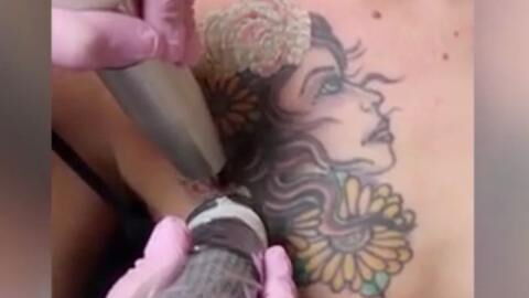A Woman Tried To Remove Her Chest Tattoo And The Outcome Is Horrific