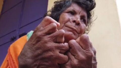 A woman who was born with 31 fingers and toes set a new Guinness World Record