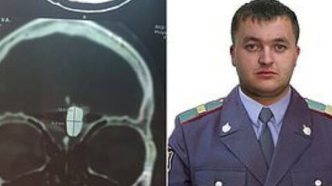 Russian Police Officer Has Been Living With a Bullet in His Brain for Over 10 Years