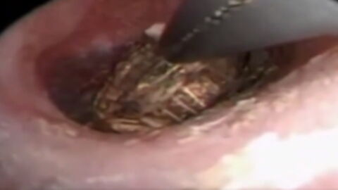 She was complaining of an earache but what they found inside was horrendous