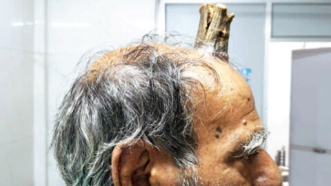 This farmer had a huge horn growing out of his head for 5 years