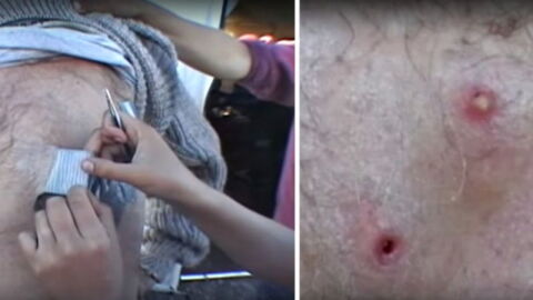 This man was horrified after his pimples turned out to be something much worse