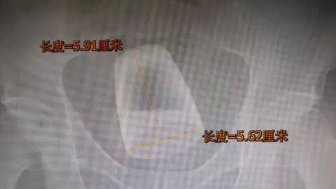 Man undergoes surgery after inserting a beer glass up his bum