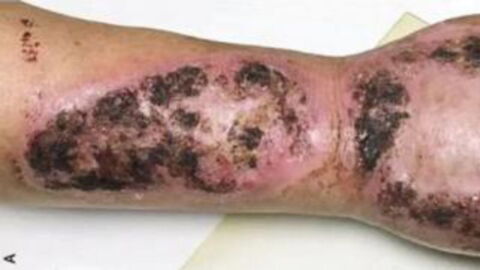 This man waited five months before going to the doctors - And was horrified by what they revealed