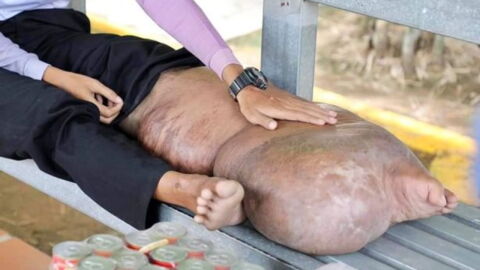 One Small Mosquito Bite Caused This Man’s Leg to Swell to the Size of a Pig