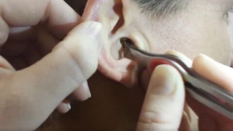 His girlfriend found something in his ear that proves why you should always clean them