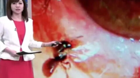 She went to the doctors for eye pain and they found something moving inside