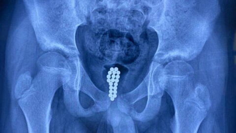 He was too embarrassed to ask for help after sticking 20 magnetic balls in a curious place