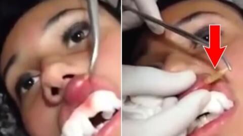 Doctor removes a horrifying parasite hiding inside a woman's lip