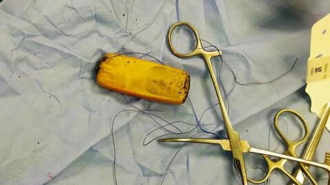Man swallowed entire phone and lived with it inside for half a year