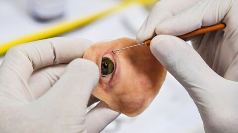 Doctors Craft A Prosthetic For A Woman's Missing Eye With A Phone And A 3D Printer
