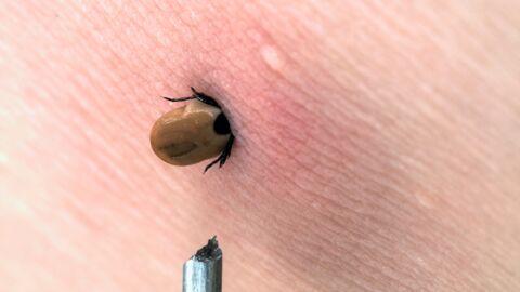 Tick bite: Alarming symptoms and what to do if you've been bitten