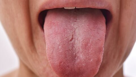 COVID tongue: The nasty new coronavirus symptom