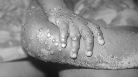 Monkeypox: Outbreak of rare viral disease has been confirmed in the UK