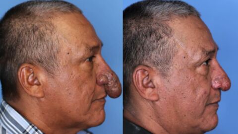 Man with 'penis-like nose' gets an incredible transformation for free