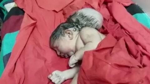 Doctors were left stunned after the birth of a rare three-headed baby