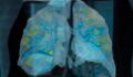 How the coronavirus affects the lungs, seen in detail on 3D video