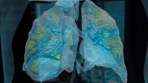 COVID: 3D video of how the coronavirus affects the lungs