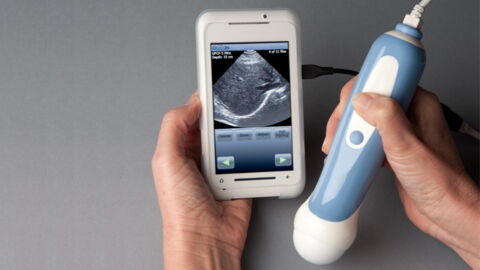 MobiUS : ce scanner à ultrasons portables se connecte à votre smartphone !