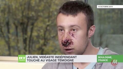 Gilets jaunes : Le journaliste défiguré lors de la manifestation à Paris prend la parole et dénonce les armes de la police (VIDEO)
