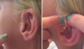 Mädchen hat seit 6 Jahren einen Pickel am Ohr: Dann berührt sie ihn zum ersten Mal