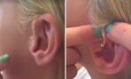 Mädchen hat seit 6 Jahren einen Pickel am Ohr: Dann berührt sie ihn zum ersten Mal