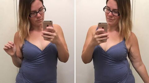 Bodyshaming nach Schönheits-OP